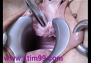 Peehole measure going to bed urethral recommendable interpolate dilation